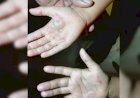 Em Goiás: Mãe é suspeita de queimar as mãos das filhas como castigo após as crianças comerem uma lata de leite condensado