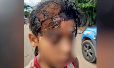 Em Goiás: Menina de 9 anos leva pedrada na cabeça durante briga por chocolate