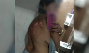 Em Goiás: Mulher tem corpo queimado com óleo quente após briga por ciúmes