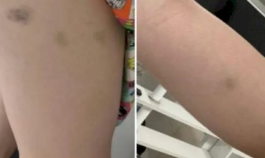 Naiara Azevedo: fotos mostram hematomas na cantora após denúncia de agressão contra ex-marido