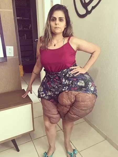 Jovem faz cirurgia inedita no Brasil e remove 30kg de tumor