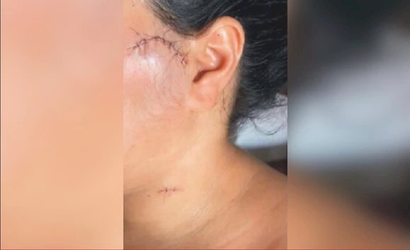 Em Uruana, Cabeleireira é atingida por 5 facadas, após o fim do relacionamento