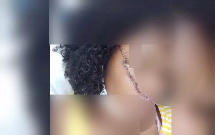 Menina leva golpe de facão no rosto ao defender amiga de agressão do namorado em Trindade