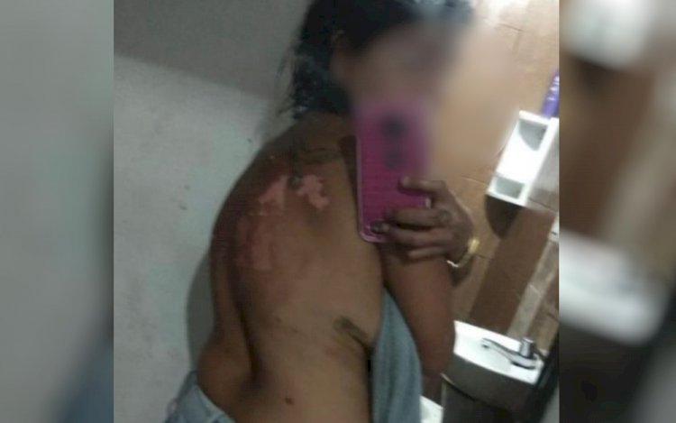 Em Goiás: Mulher tem corpo queimado com óleo quente após briga por ciúmes