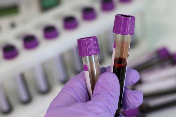 Cientistas desenvolvem exame de sangue inovador para identificar esquizofrenia